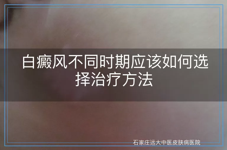 白癜风不同时期应该如何选择治疗方法
