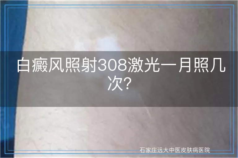 白癜风照射308激光一月照几次？