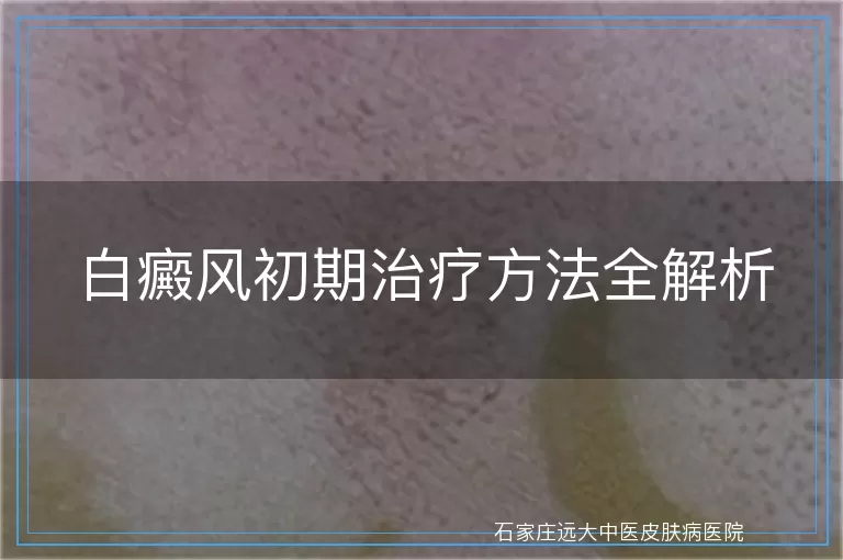 白癜风初期治疗方法全解析