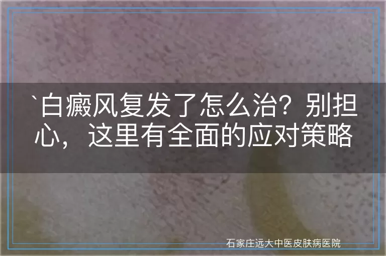 白癜风复发了怎么治？别担心，这里有全面的应对策略