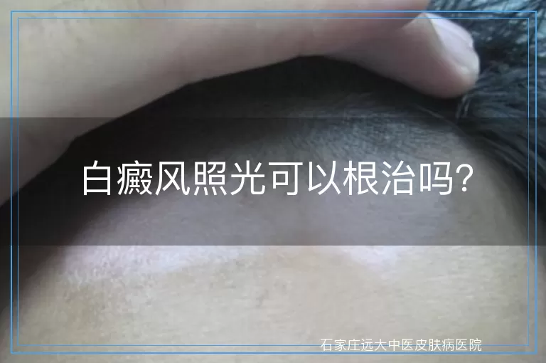白癜风照光可以根治吗？