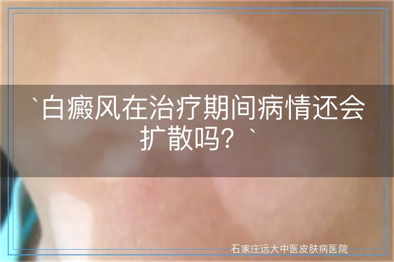 白癜风在治疗期间病情还会扩散吗？