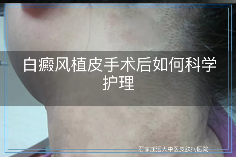 白癜风植皮手术后如何科学护理