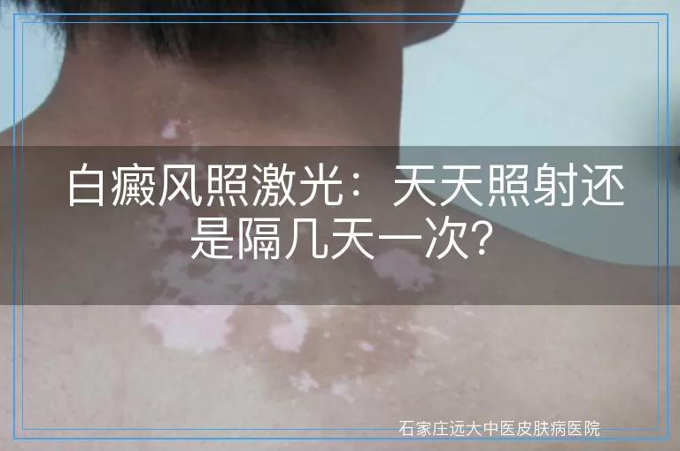 白癜风照激光：天天照射还是隔几天一次？