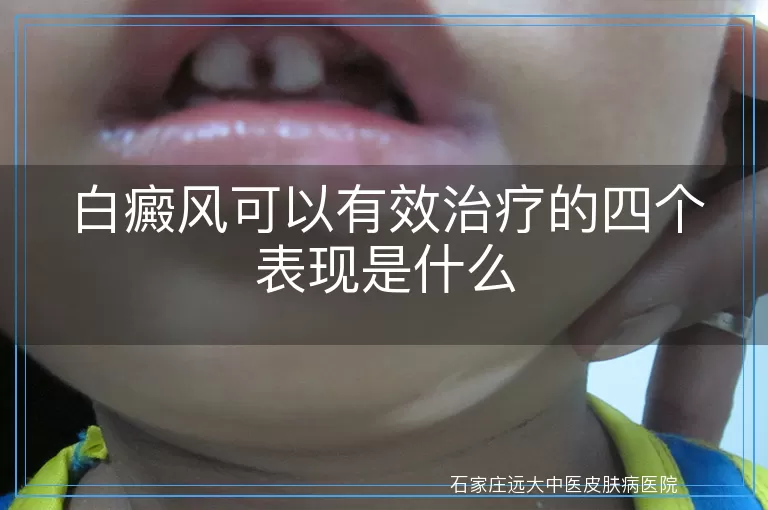 白癜风可以有效治疗的四个表现是什么