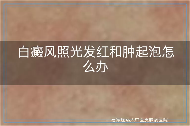 白癜风照光发红和肿起泡怎么办