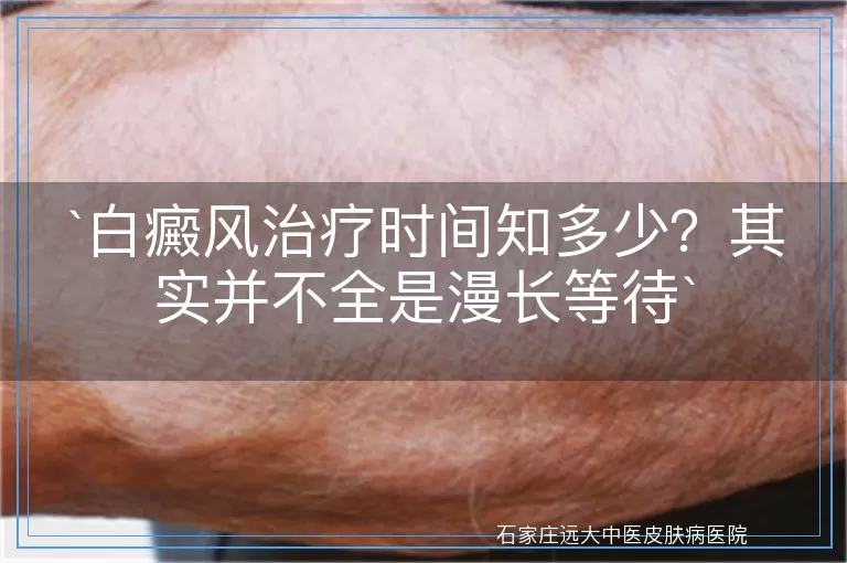 白癜风治疗时间知多少?其实并不全是漫长等待