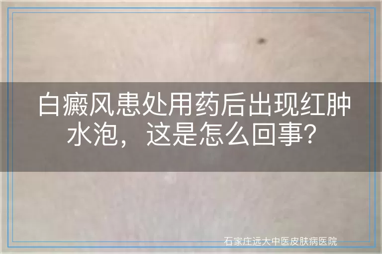白癜风患处用药后出现红肿水泡，这是怎么回事？