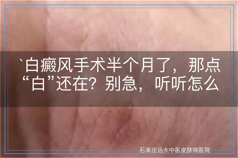 白癜风手术半个月了，那点“白”还在？别急，听听怎么说