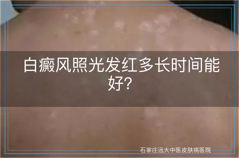 白癜风照光发红多长时间能好?