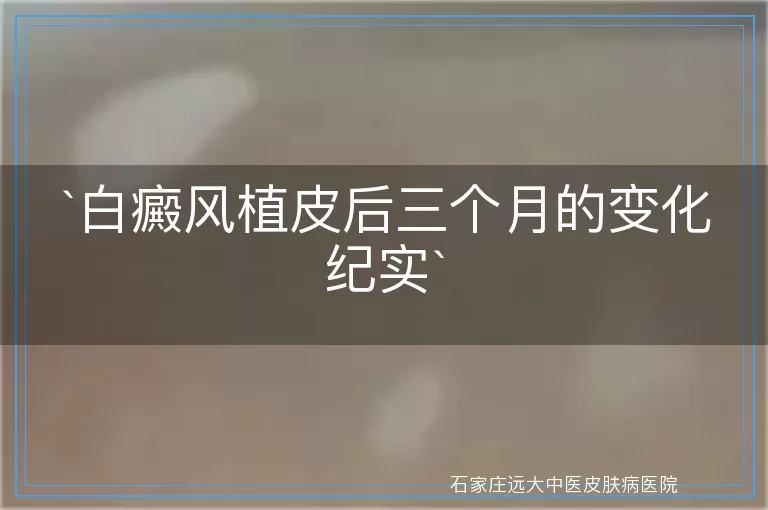 白癜风植皮后三个月的变化纪实