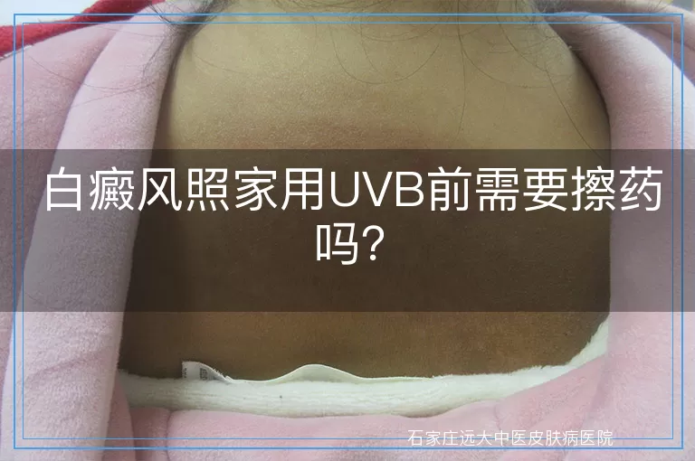 白癜风照家用UVB前需要擦药吗？