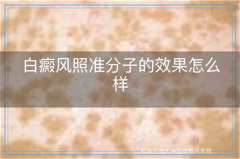 白癜风照准分子的效果怎么样