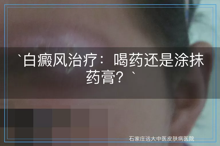 白癜风治疗：喝药还是涂抹药膏？