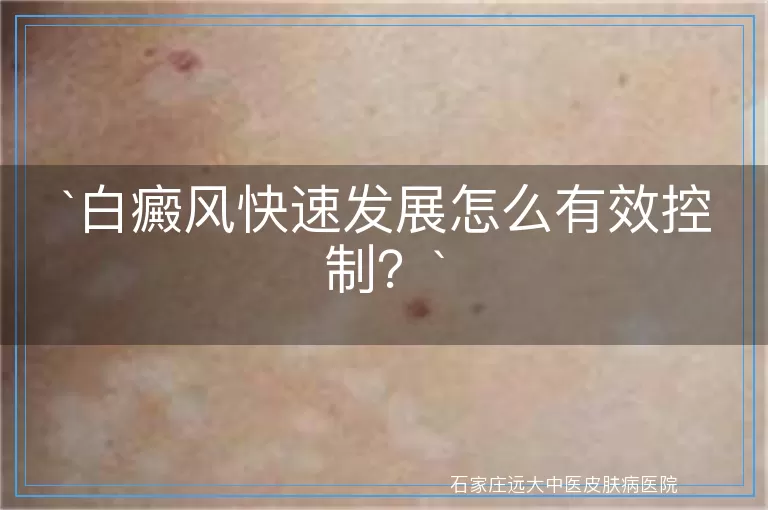 白癜风快速发展怎么有效控制？