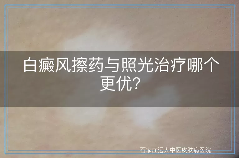 白癜风擦药与照光治疗哪个更优？
