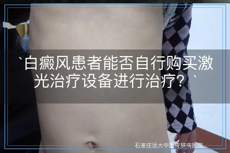 白癜风患者能否自行购买激光治疗设备进行治疗？
