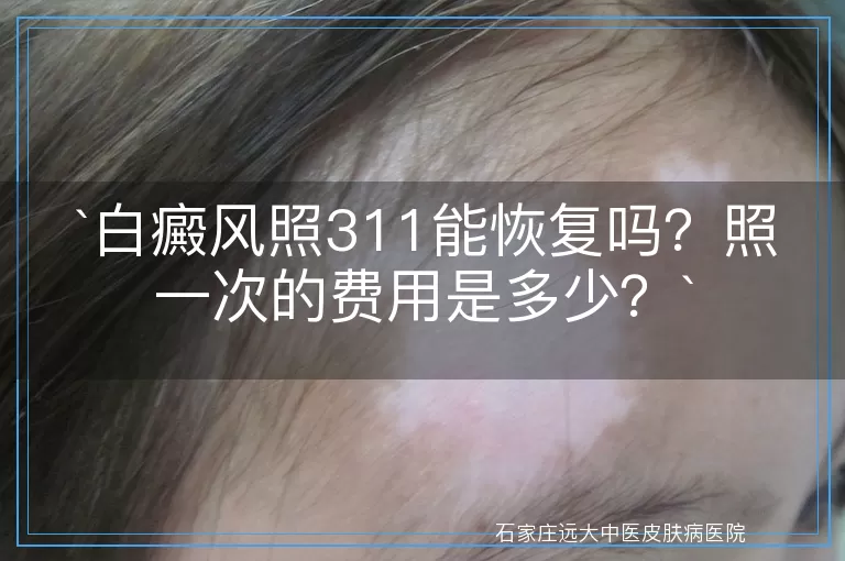 白癜风照311能恢复吗？照一次的费用是多少？