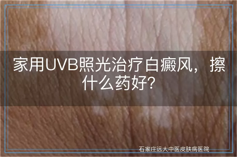 家用UVB照光治疗白癜风，擦什么药好？