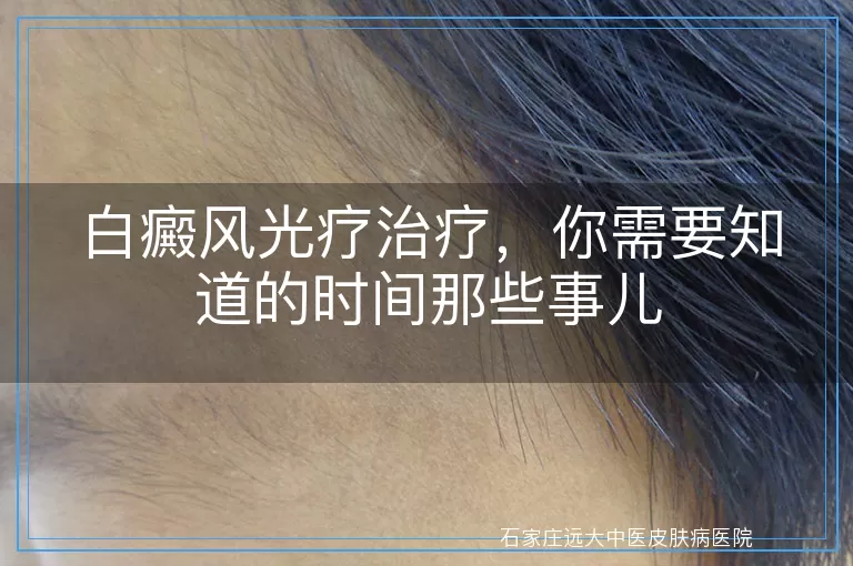 白癜风光疗治疗，你需要知道的时间那些事儿