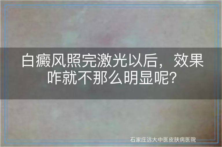 白癜风照完激光以后，效果咋就不那么明显呢？