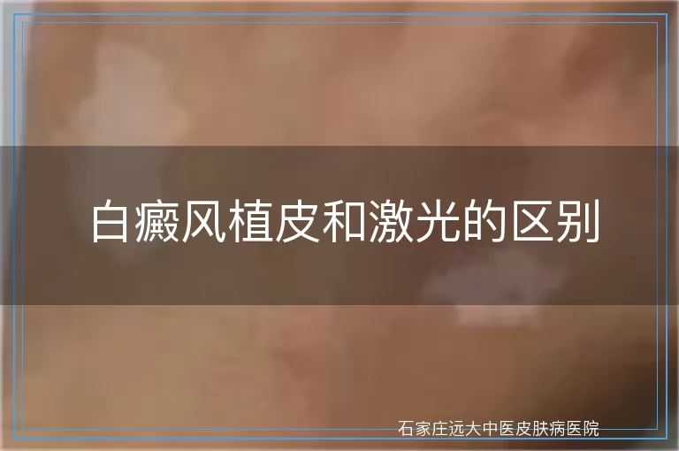 白癜风植皮和激光的区别