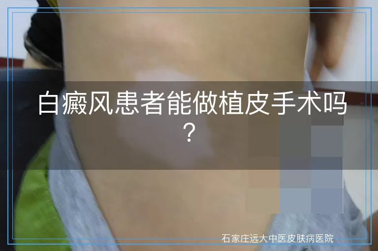 白癜风患者能做植皮手术吗？