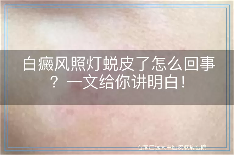 白癜风照灯蜕皮了怎么回事？一文给你讲明白！