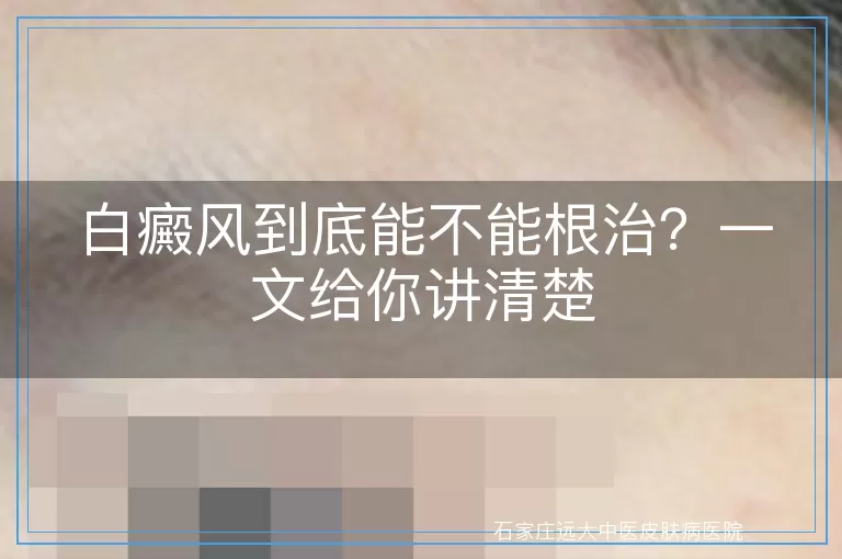 白癜风到底能不能根治？一文给你讲清楚