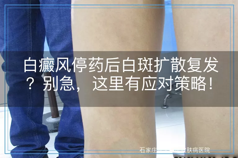 白癜风停药后白斑扩散复发？别急，这里有应对策略！