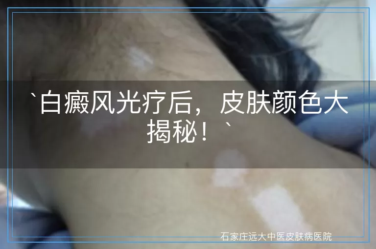 白癜风光疗后，皮肤颜色大揭秘！