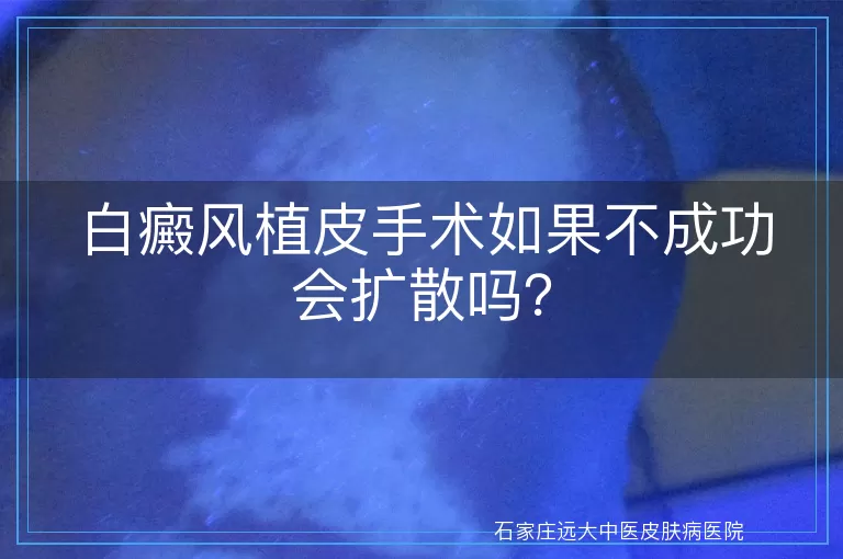 白癜风植皮手术如果不成功会扩散吗？