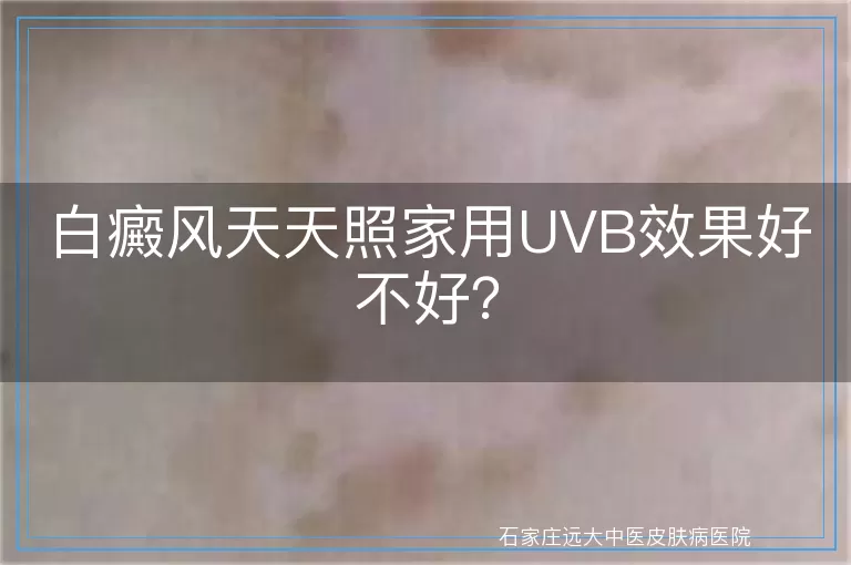白癜风天天照家用UVB效果好不好？