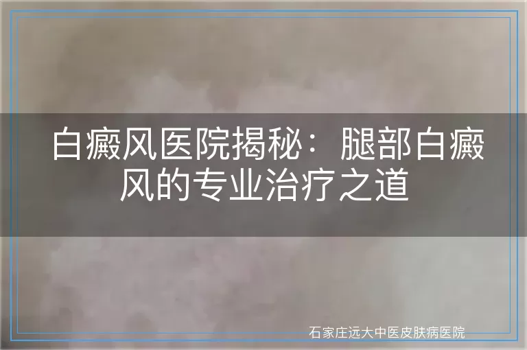 白癜风医院揭秘：腿部白癜风的专业治疗之道