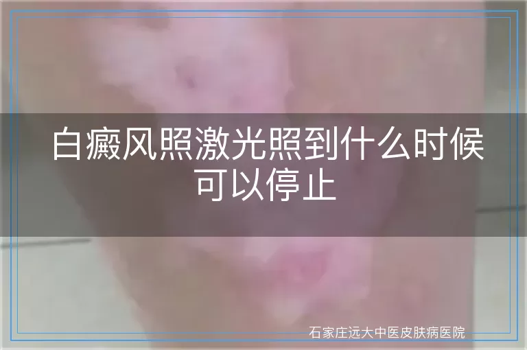 白癜风照激光照到什么时候可以停止