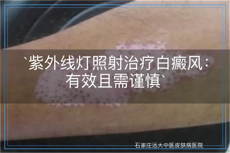 紫外线灯照射治疗白癜风：有效且需谨慎
