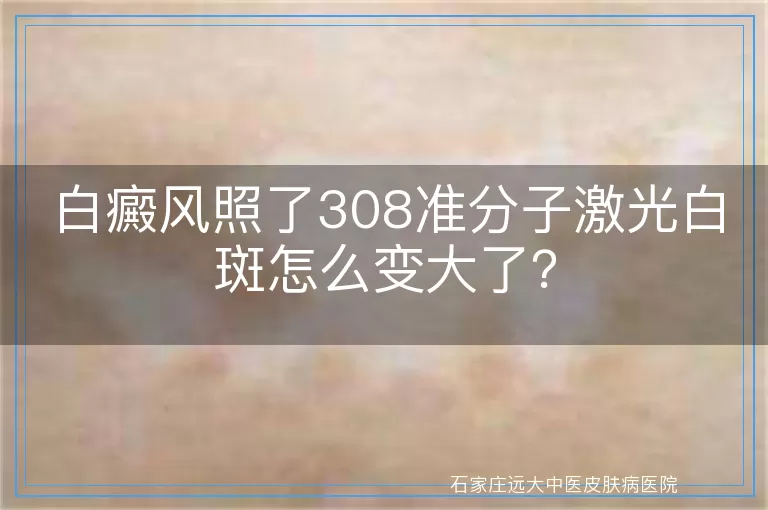 白癜风照了308准分子激光白斑怎么变大了？