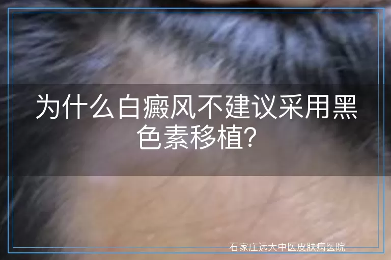 为什么白癜风不建议采用黑色素移植？