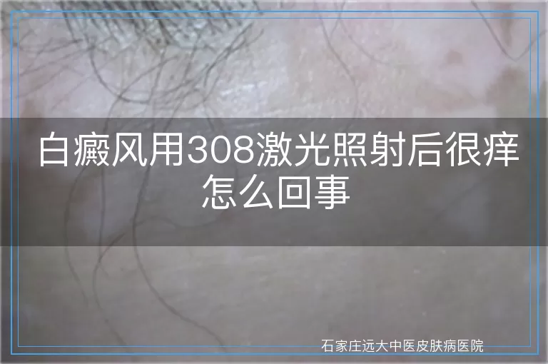 白癜风用308激光照射后很痒怎么回事
