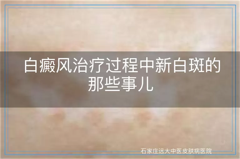 白癜风治疗过程中新白斑的那些事儿