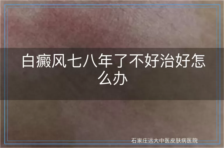 白癜风七八年了不好治好怎么办