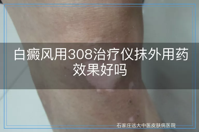 白癜风用308治疗仪抹外用药效果好吗