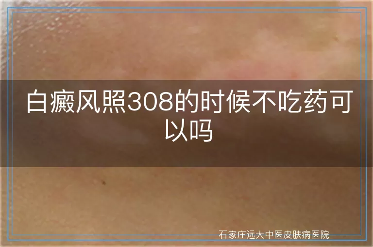 白癜风照308的时候不吃药可以吗