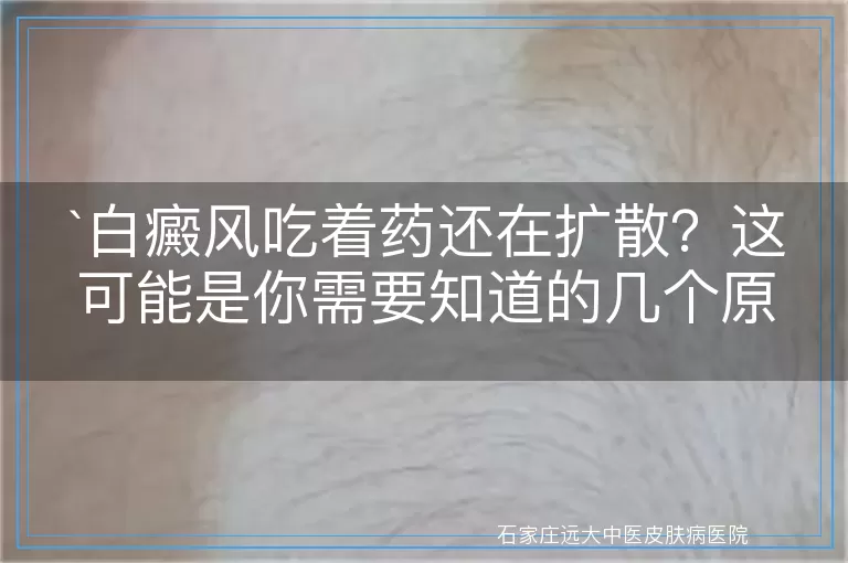 白癜风吃着药还在扩散？这可能是你需要知道的几个原因