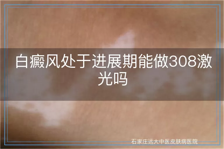 白癜风处于进展期能做308激光吗