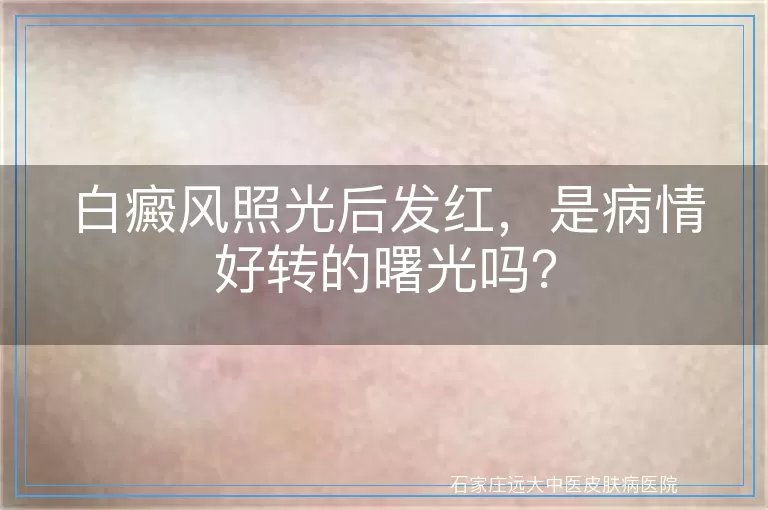 白癜风照光后发红，是病情好转的曙光吗？