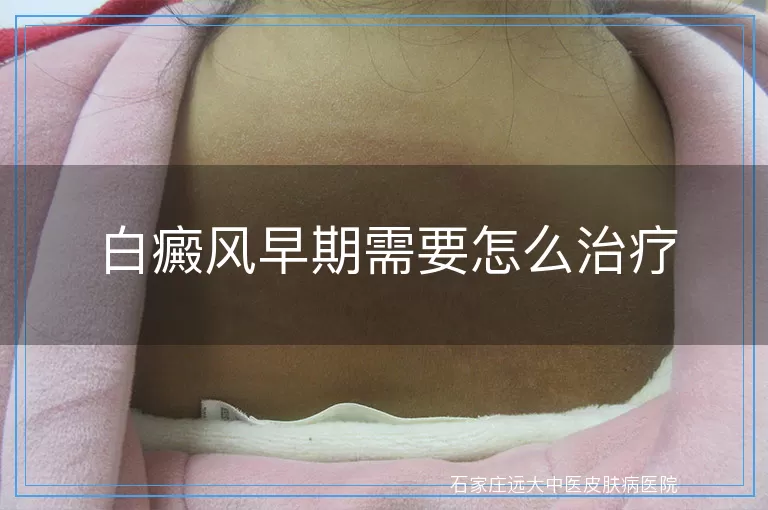 白癜风早期需要怎么治疗