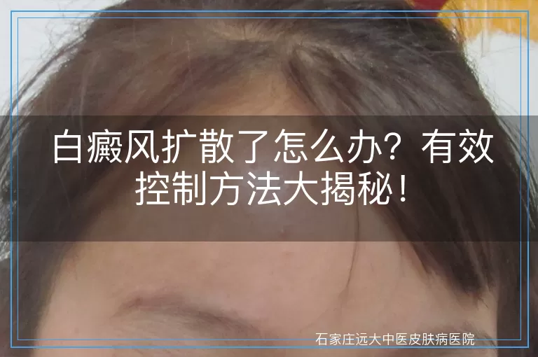 白癜风扩散了怎么办?有效控制方法大揭秘!