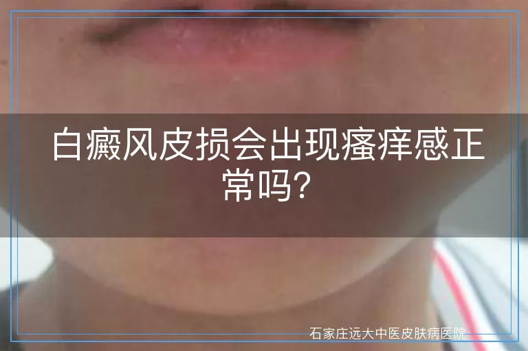 白癜风皮损会出现瘙痒感正常吗？