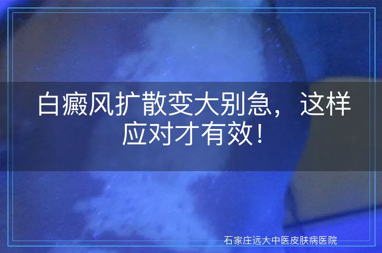 白癜风扩散变大别急，这样应对才有效！